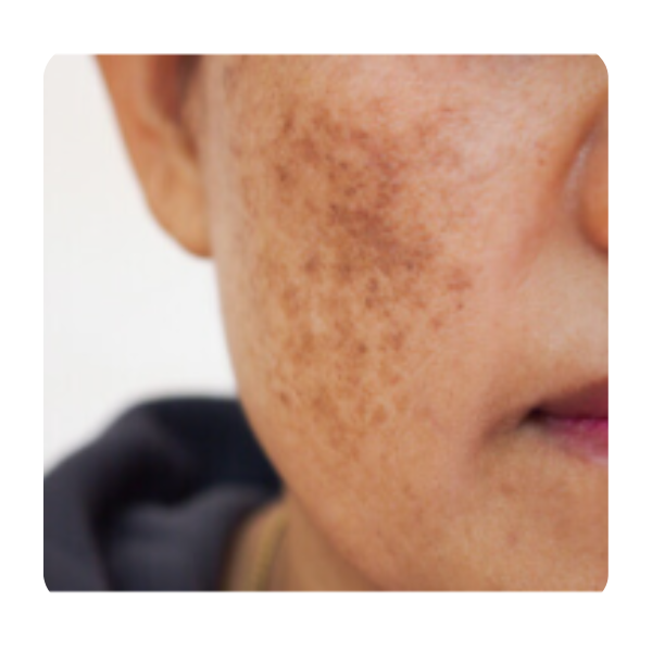 Melasma Facial