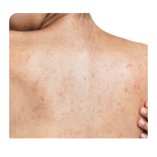 Foliculite ou Manchas no Bumbum